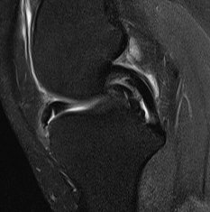 Medial Meniscus Bucket Handle Tear Anterior Flipped Meniscus